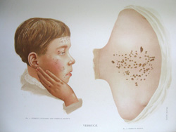 Atlas of the Diseases of the Skin: Warts