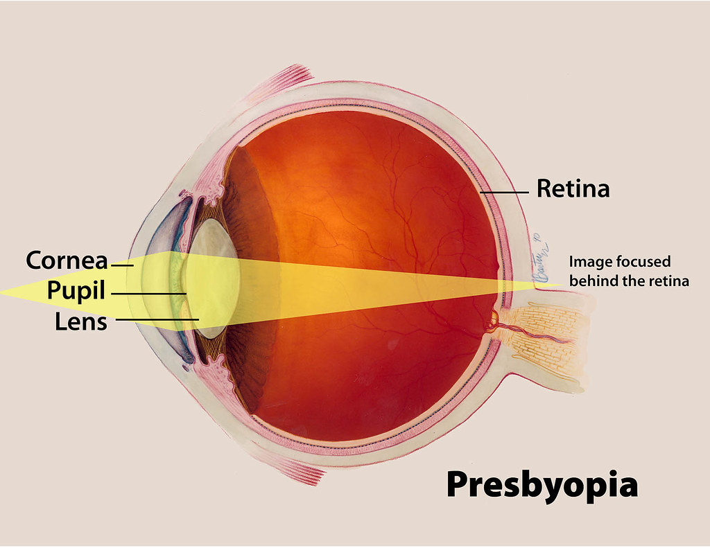 what do blind peoples eyes look like