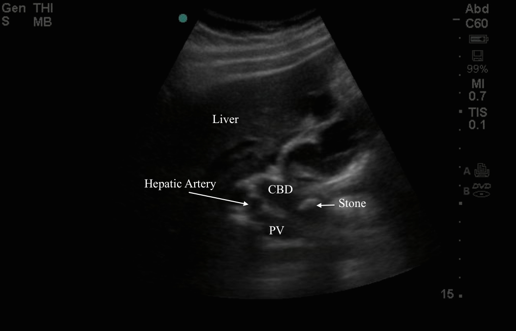 hepatic artery ultrasound