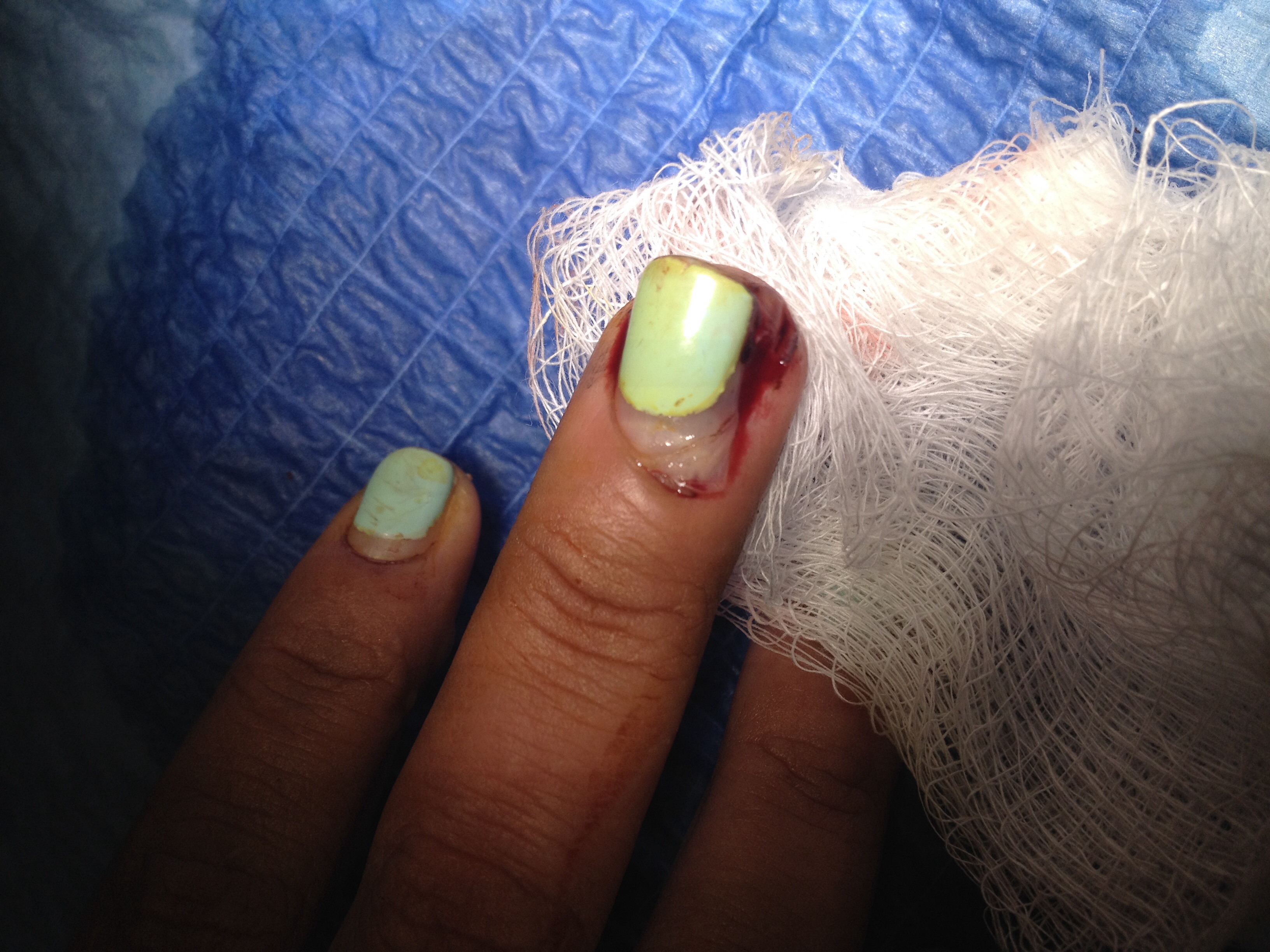 in-patients-with-partial-nail-avulsion-with-preserved-nail-structure
