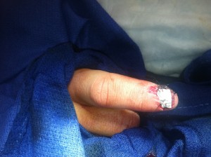 nail bed laceration repaired