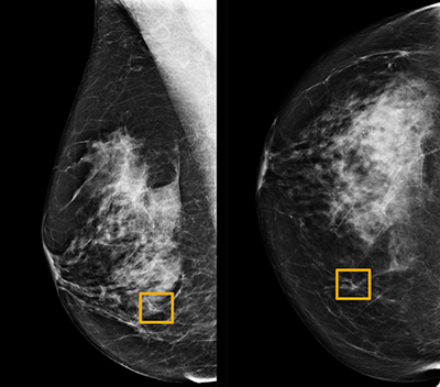 Breast Cancer Image