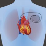 pacemaker illustration
